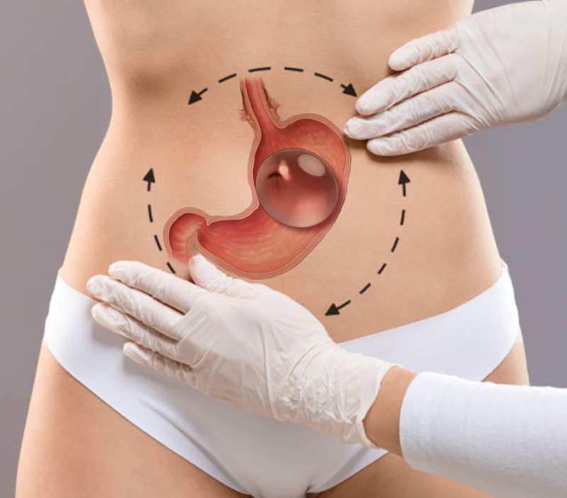 Ballon gastrique