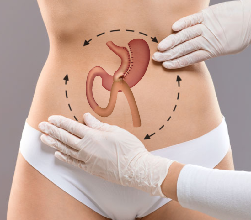 Bypass gastrique