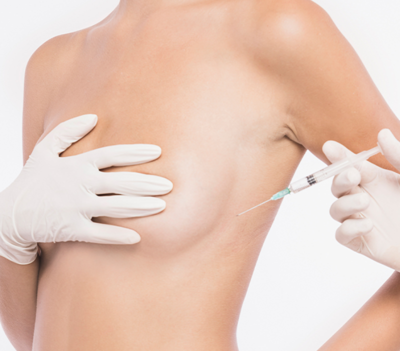 Augmentation mammaire avec lipofilling mammaire