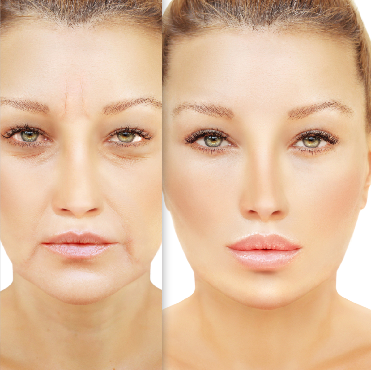 lipofilling du visage