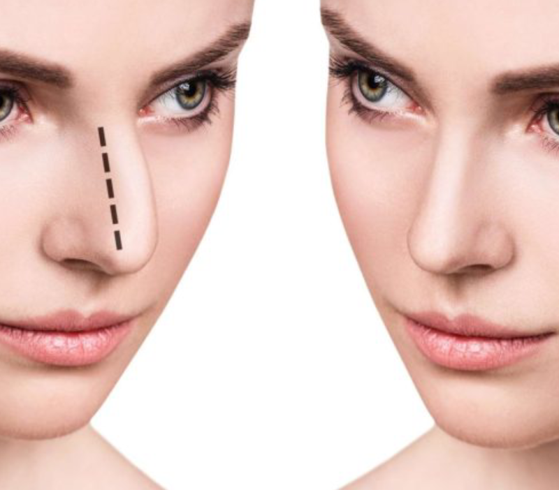 Rhinoplastie