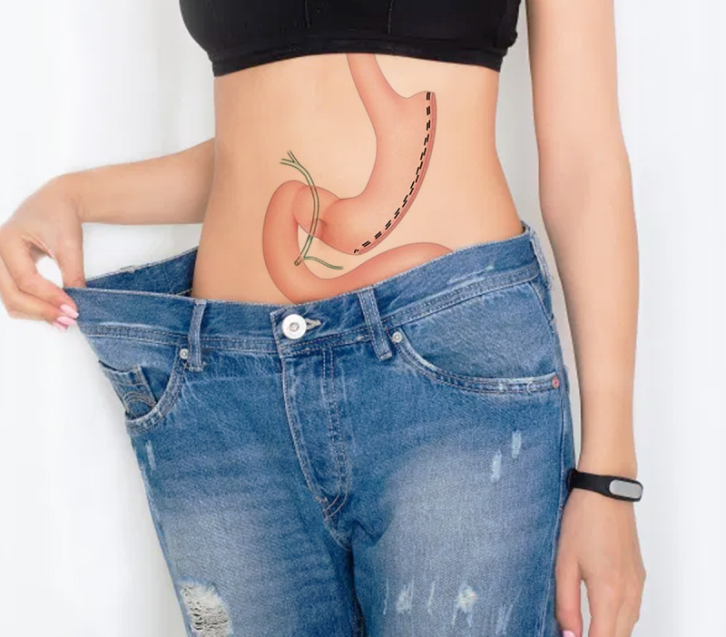 Sleeve gastrectomie
